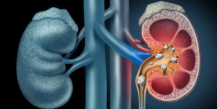 urolithiasis